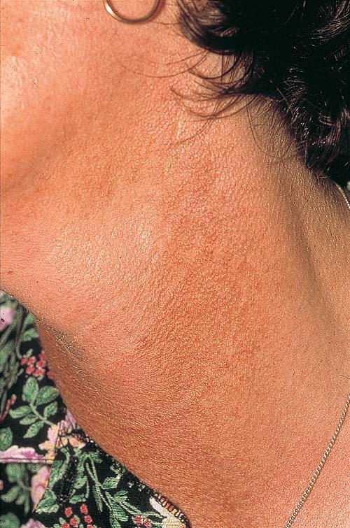 What is Poikiloderma of Civatte, and how to treat it?
