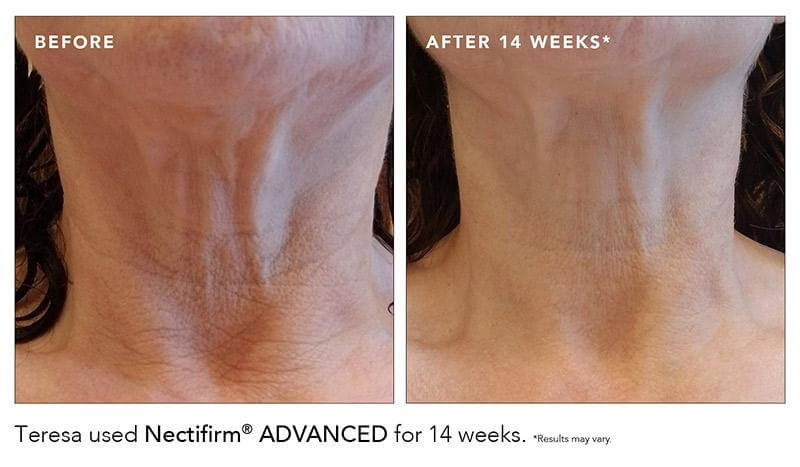 revision neck before after