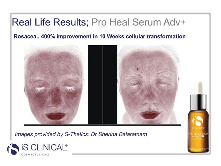iS Clinical Pro-Heal Serum results (before and after image) iS Clinical Pro-Heal Serum results (before and after image)