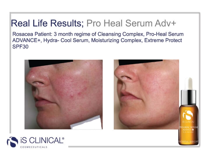 iS Clinical Pro-Heal Serum results (before and after client photo) iS Clinical Pro-Heal Serum results (before and after client photo)