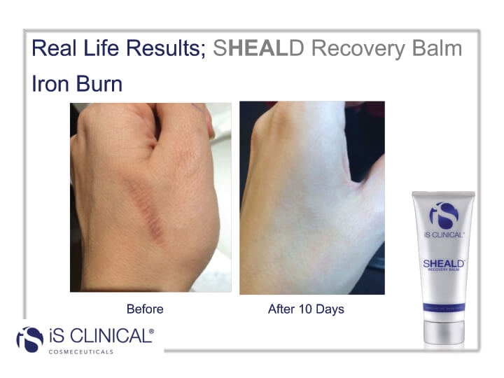 Before and After photos of using Sheald Recovery on iron burn Before and After photos of using Sheald Recovery on iron burn