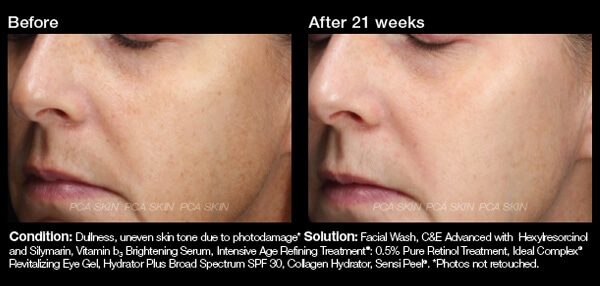Vitamin B3 Before and After Vitamin B3 Before and After