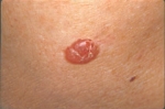 Image of Basal Cell Carcinoma (BCC) Image of Basal Cell Carcinoma (BCC)