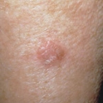 Image of Squamous Cell Carcinoma (SCC) Image of Squamous Cell Carcinoma (SCC)