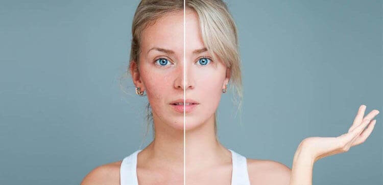 rosacea rosacea