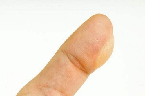 blister blister