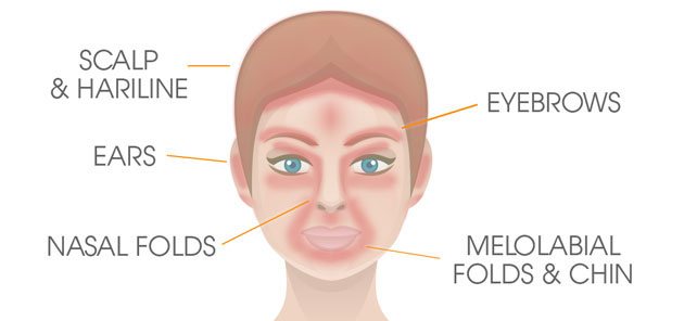 Where sebhorrheic dermatitis can appear on the face Where sebhorrheic dermatitis can appear on the face