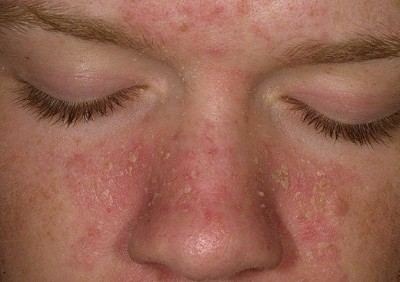 Close up of seborrhoeic dermatitis sufferer Close up of seborrhoeic dermatitis sufferer