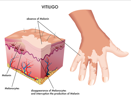 Image of skin structure of vitiligo sufferer Image of skin structure of vitiligo sufferer